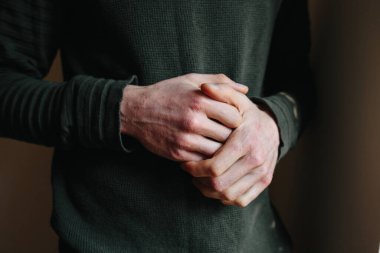 Sedef hastalığı ya da egzama hastalığı olan eller, cilt ile ilgili sağlık sorunları. Elinde sedef hastalığı olan kurumuş pullu bir cilt.