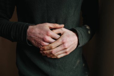 Sedef hastalığı ya da egzama hastalığı olan eller, cilt ile ilgili sağlık sorunları. Elinde sedef hastalığı olan kurumuş pullu bir cilt.