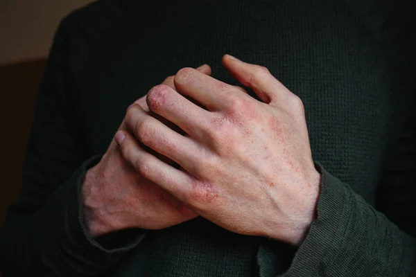 Manos con psoriasis o eczema, Problemas de salud en la piel. Piel escamosa seca en la mano con psoriasis vulgar — Foto de Stock