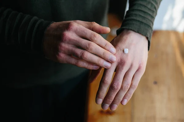 Aplicar un emoliente sobre la piel seca escamosa, como en el tratamiento de la psoriasis, el eccema y otras afecciones de la piel seca. Fondo verde —  Fotos de Stock