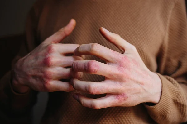 Dermatite alérgica cutânea dermatite eczema pele do paciente. Homem coceira pele com psoríase — Fotografia de Stock