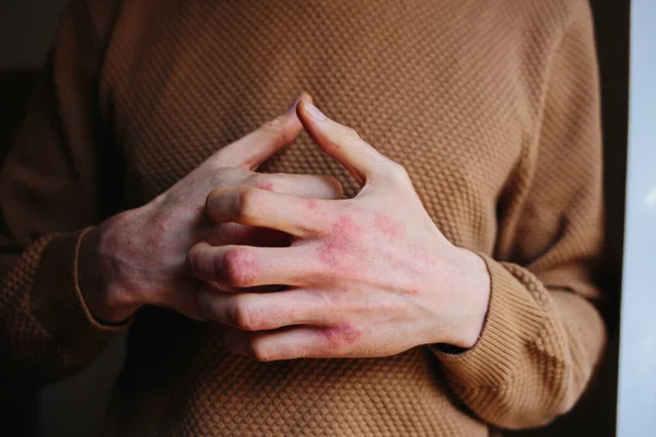 Alerjik dermatit egzama hastası derisi. Sedef hastalığıyla kaşınan bir adam. — Stok fotoğraf