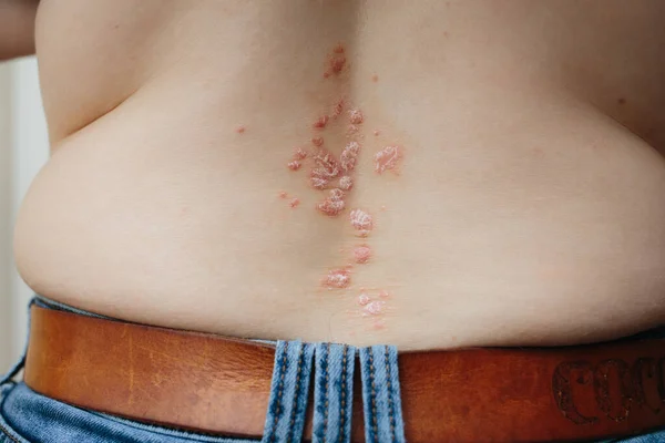 Πρόβλημα υγείας, δερματική νόσος, δερματίτιδα στην πλάτη, κοντά. Ψωρίαση στο δέρμα — Φωτογραφία Αρχείου