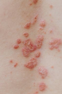 Egzama atopik dermatit semptom deri detay dokusu. Deride sedef lekeleri var.