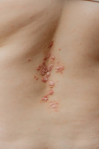 Health problem, skin disease, dermatitis on the back, close up. Psoriasis on skin