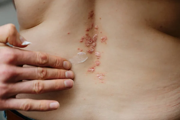 Woman applying moisturizer to skin with psoriasis. Eczema skin problem — Stock Photo, Image