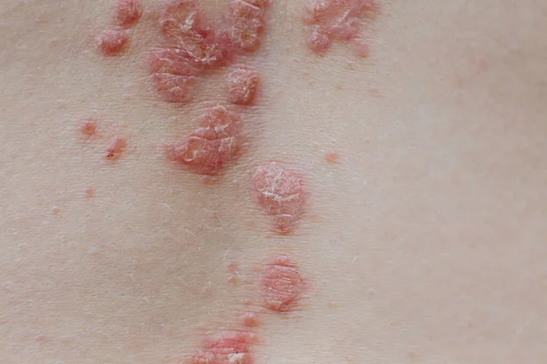 Eksim atopic dermatitis symptom tekstur kulit detail. Psoriasis bintik pada kulit — Stok Foto