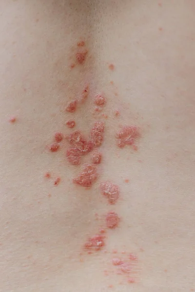 Eczeem atopische dermatitis symptoom huid detail textuur. Psoriasis vlekken op de huid — Stockfoto