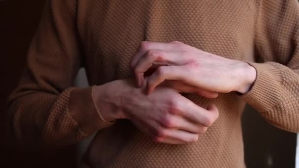 Мужские царапины проблемная кожа, как его руки страдают от псориаза, аутоиммунного состояния кожи — стоковое видео