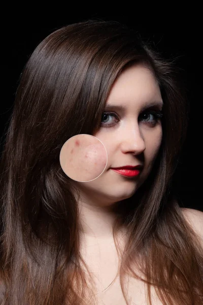 女性护肤观念。粉刺摘除前后年轻女子的大学肖像 — 图库照片