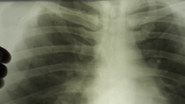 Yakın plan bir kadının akciğer röntgenini inceleyen deneyimli bir doktorun elleri. X-ray konsepti.