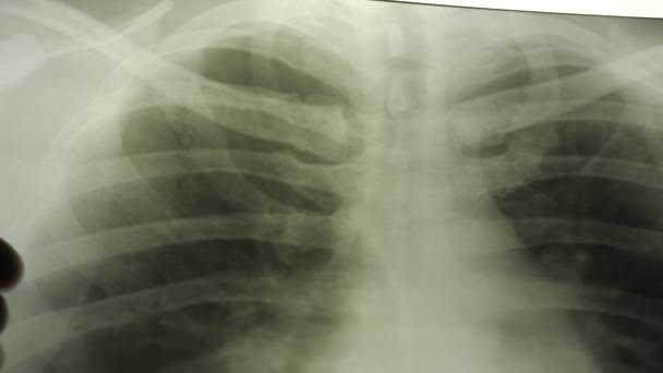 Nahaufnahme der Hände eines erfahrenen Arztes, der das Lungenröntgen einer Frau aus nächster Nähe untersucht. Röntgenkonzept. — Stockvideo