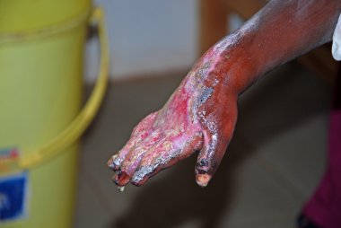 bir çocuk Afrika-Tanzanya-Afrika yardım için ciddi yanıklar