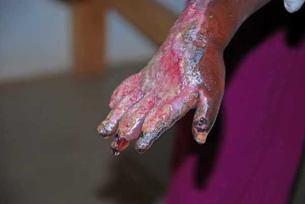 Las graves quemaduras en la mano de un niño Africano-Tanzania-África — Foto de Stock