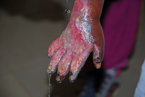 Las graves quemaduras en la mano de un niño Africano-Tanzania-África — Foto de Stock