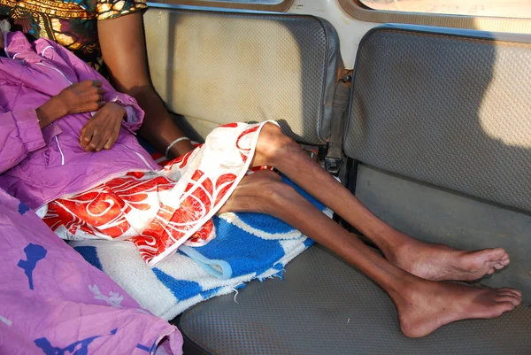 Una bambina con il virus dell'AIDS, e una forte malnutrizione è — Foto Stock