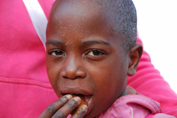 The skin of a child sick with AIDS — Stock Photo, Image