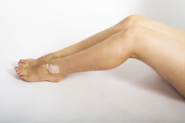 vitiligo hastalığı olan kadın bacakları