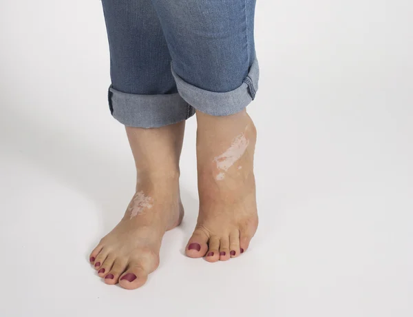 Женские ноги с болезнью витилиго — стоковое фото