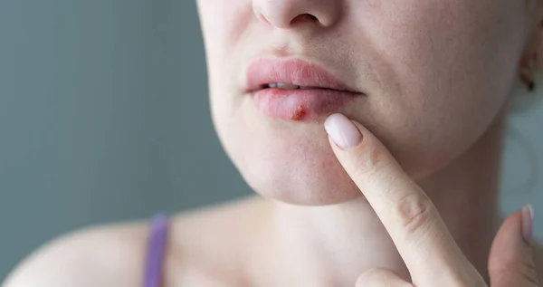 La mujer con un virus herpes en los labios —  Fotos de Stock