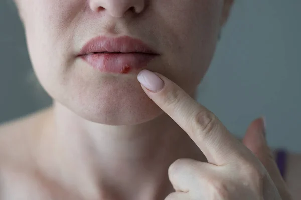 La mujer con un virus herpes en los labios — Foto de Stock