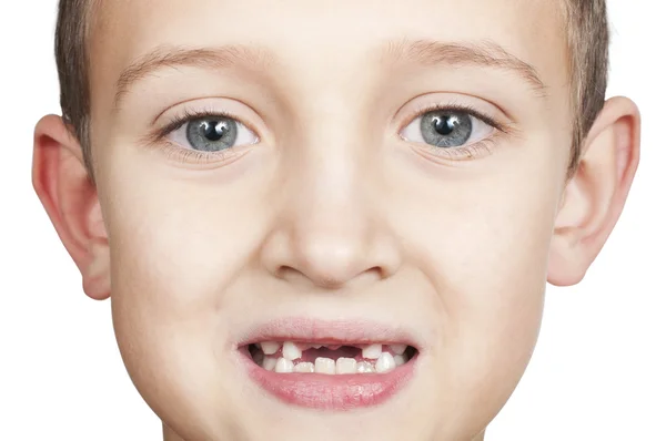 Pérdida de dientes primarios en niños — Foto de Stock