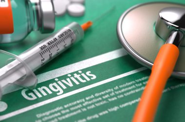 Tanı - Gingivitis. Tıp kavramı.