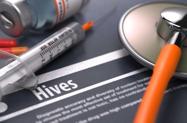 Hives - Printed Diagnosis on Grey Background.