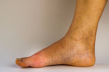 Sağ ayak, acı, kızarıklık, akut artrit gut yüzünden baş parmağın şişmesi ve hassasiyeti..