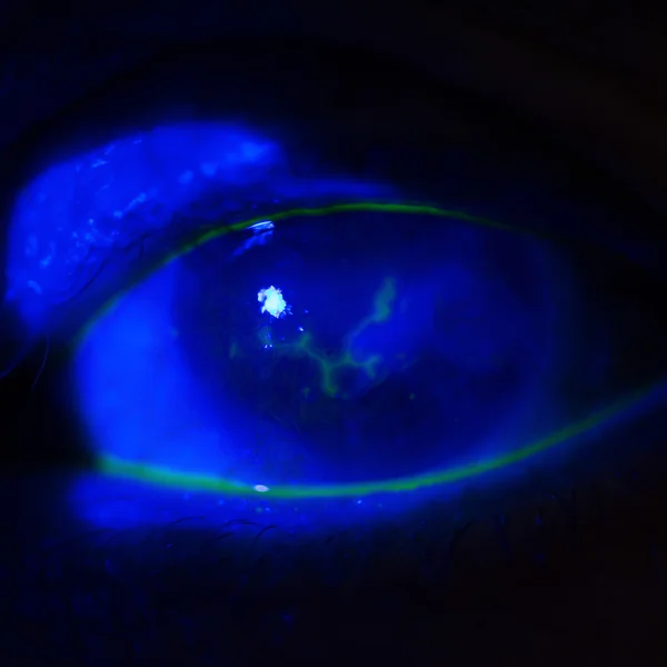 Herpes keratitis at eye test — Stock Photo © arztsamui 106593506