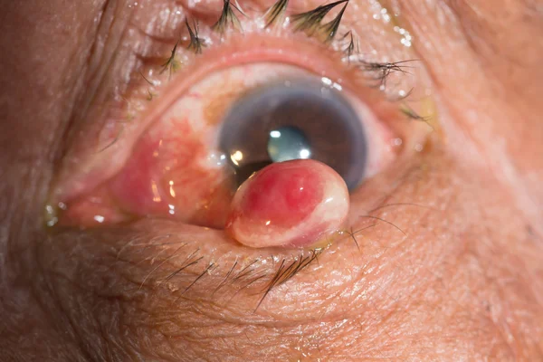 Pyogenic granuloma at eye test — Stock Photo, Image