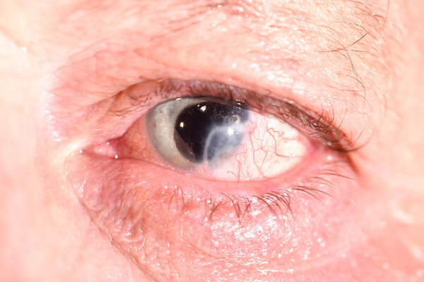 eye with iris lost and corneal scar.