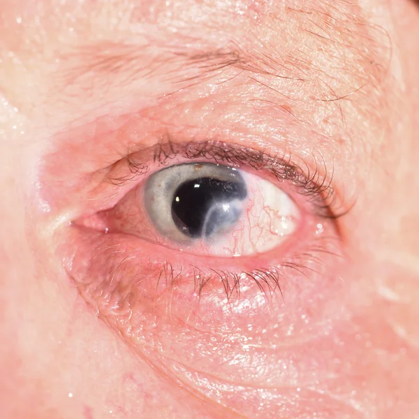 Post-traumatisk med protese kontaktlinse . – stockfoto
