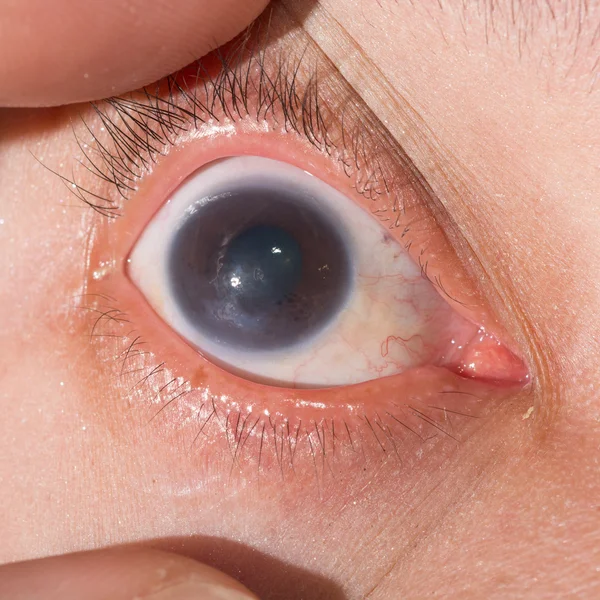 Keratitis on eye test — Stock Photo, Image