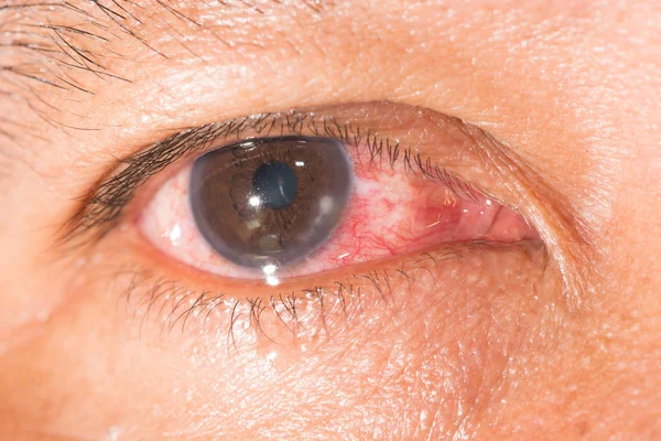 Marginal keratitis pada tes mata — Stok Foto