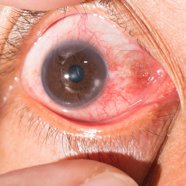 Marginale keratitis op oogtest — Stockfoto