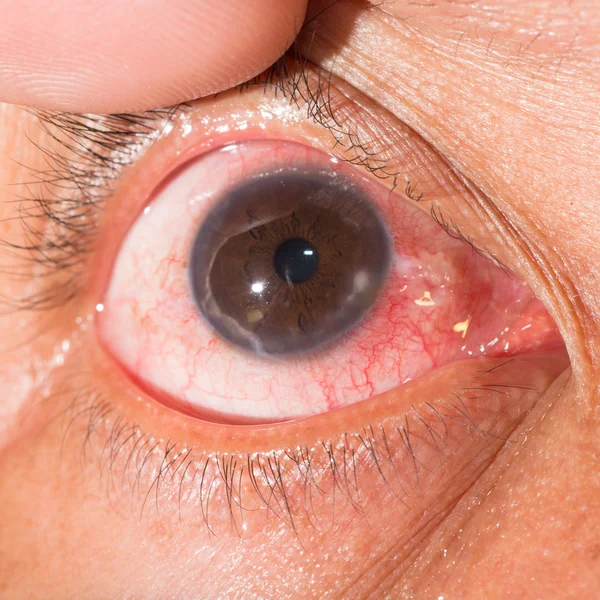 Marginal keratitis on eye test — Stock Photo, Image