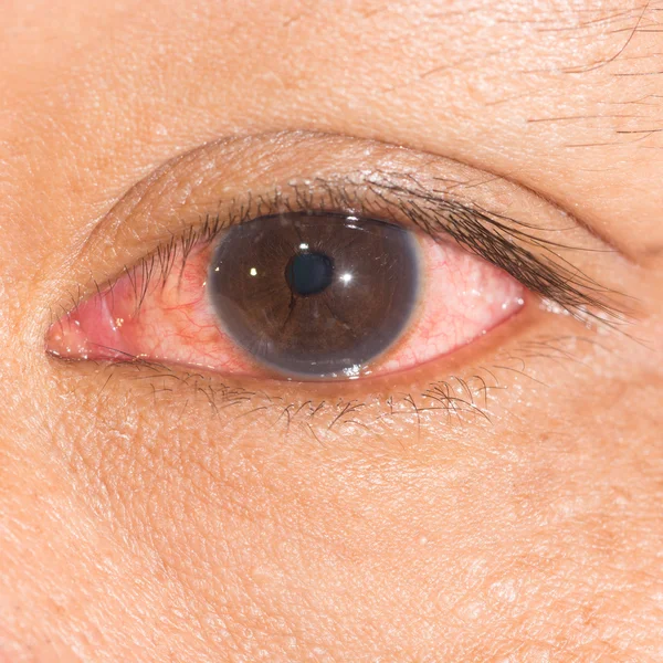 Konjonktivit göz testi sırasında — Stok fotoğraf