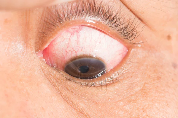 Επιπεφυκίτιδα στο μάτι δοκιμή — Φωτογραφία Αρχείου