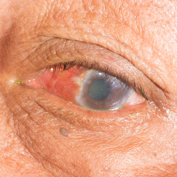 Glaukom beim Augentest — Stockfoto