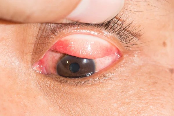 Zapalenie spojówek oka test — Zdjęcie stockowe