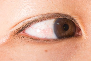 pinguecula at eye test clipart