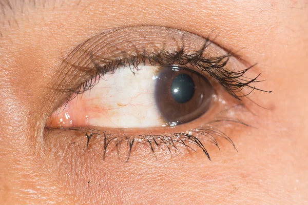 Conjunctival nevi at eye test — Stock Photo, Image