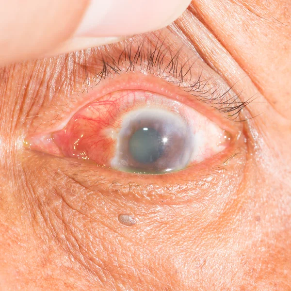 Angel closure glaucoma at eye test — Stock Photo, Image