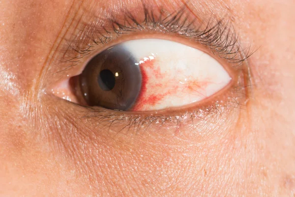 Subconjunctival bloeding op oogtest — Stockfoto