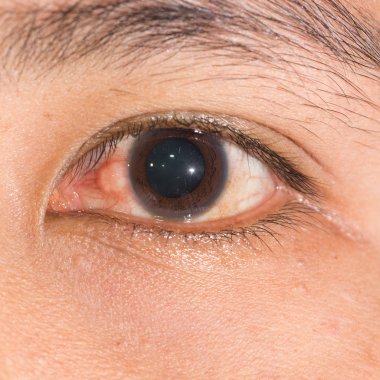 göz testi olarak Nodüler episcleritis