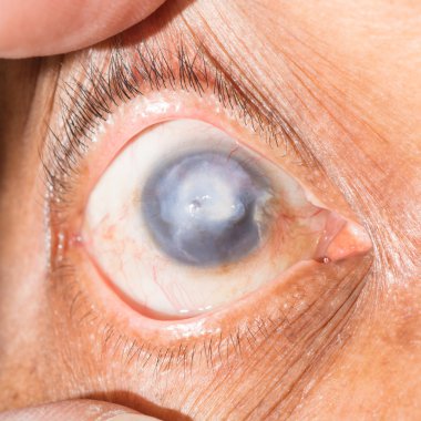 corneal scar at eye test clipart
