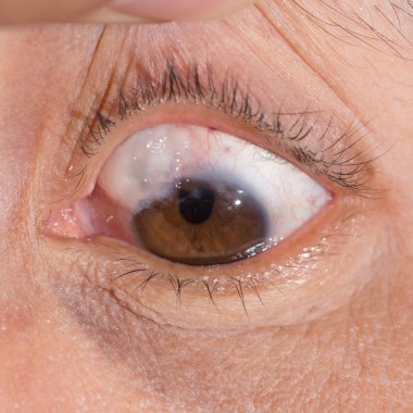 trabeculectomy bleb göz testi