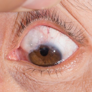 trabeculectomy bleb göz testi