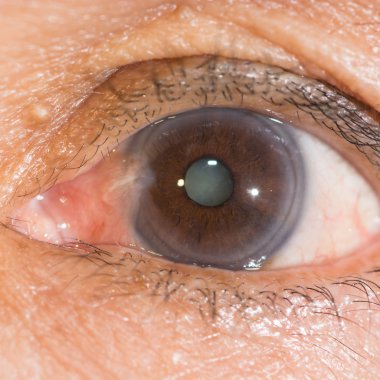 pterjium ve Senil katarakt, göz testi